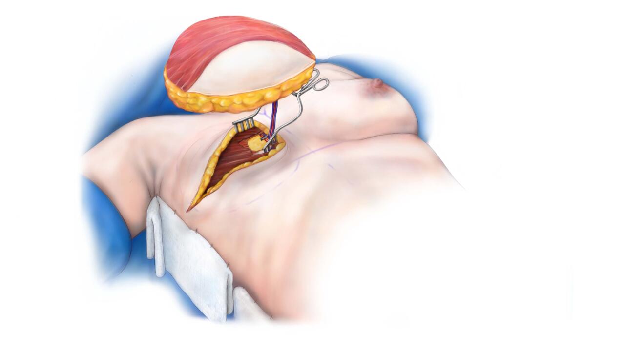 borstreconstructie diep flap, vetweefsel uit buik wordt geplaatst op de borstkas.