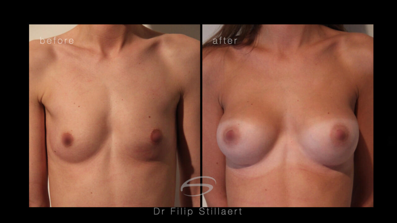 Het vergroten van de borst met implantaten, prothesen