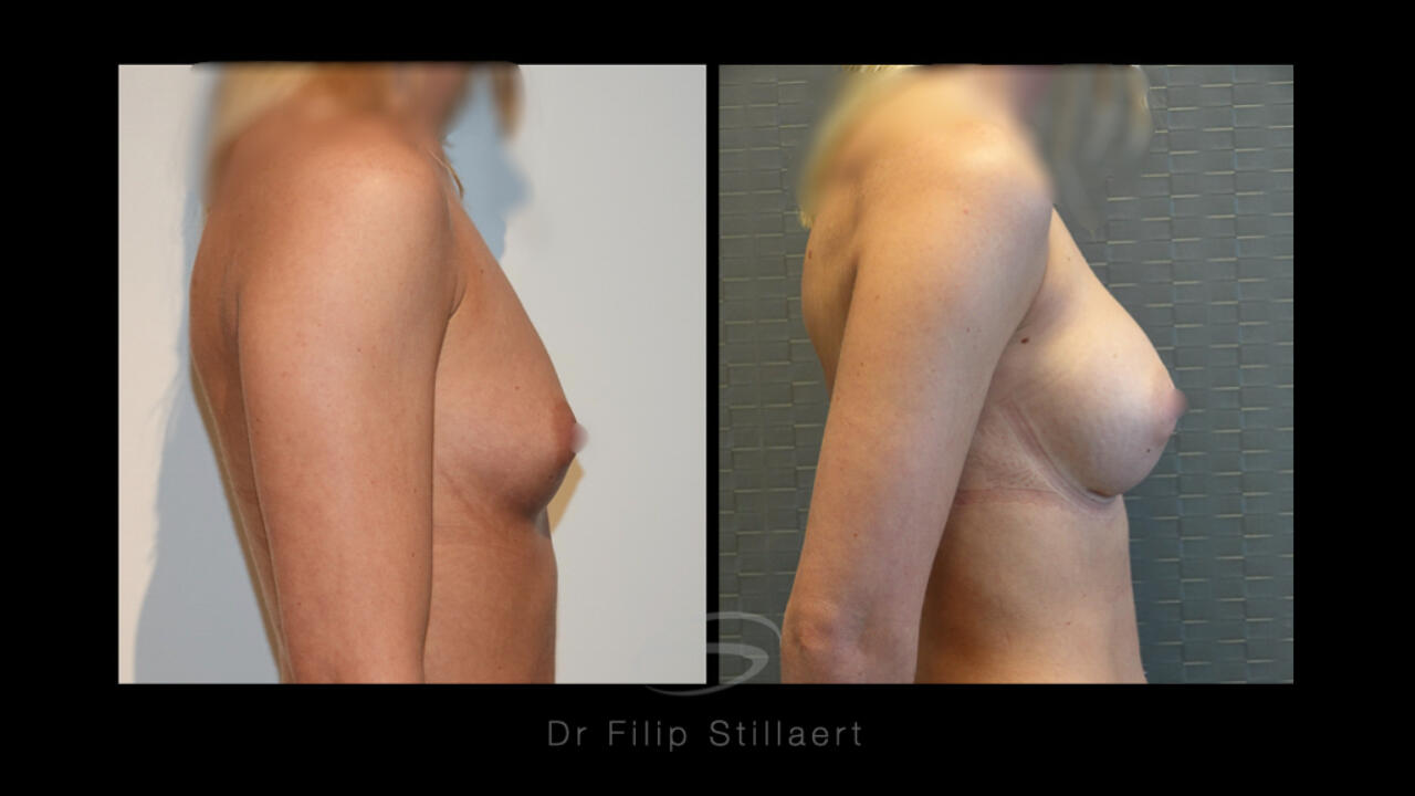 Voor en na foto's borstvergroting met Motiva prothese