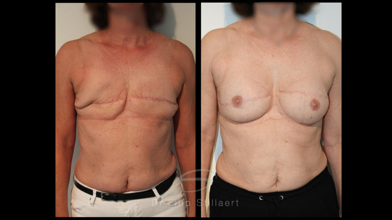 hybrid breast reconstruction