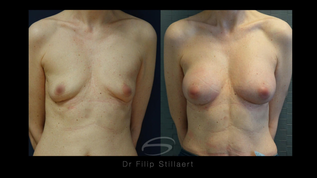 Foto's voor en na van kleine borsten en verzwakte huid