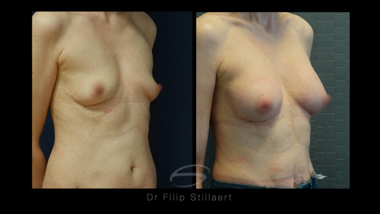 Verbeteren van symmetrie tussen de borsten en een voller decolleté met implantaten/protheses