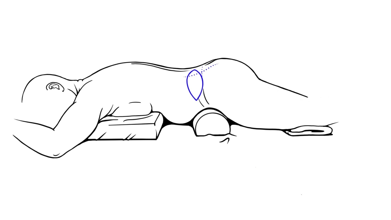 borstreconstructie met lumbar flap